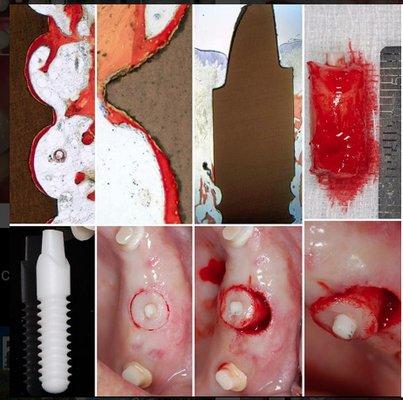 This is a REAL HUMAN HISTOLOGY of an implant trephined 3 months after it was inserted. A 65y/o patient  part of research donated an implant