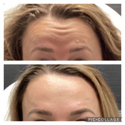 botox before after