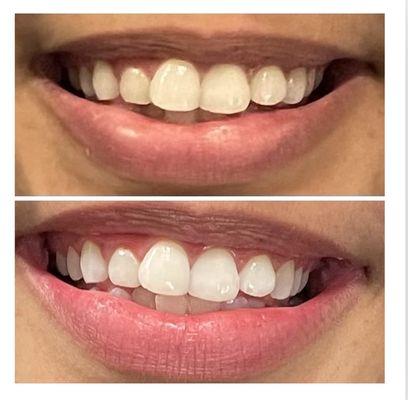 Teeth Whitening Before & After