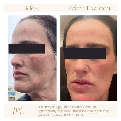 After only ONE treatment of IPL we were able to significantly reduce sun spots on this client for more clear, youthful skin!