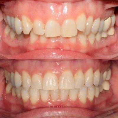 -Expanded upper and lower arches
-Aligned edges of front teeth
-Opened deep overbite
Total treatment time 23 months