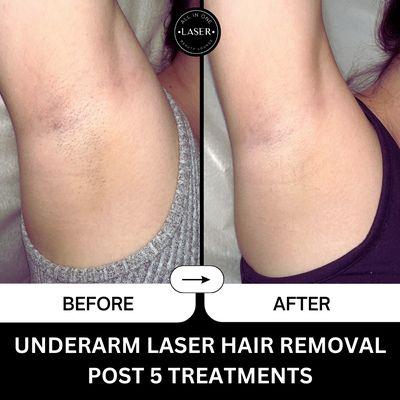 Underarm laser hair removal