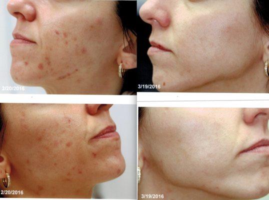 Before & After Acne treatments