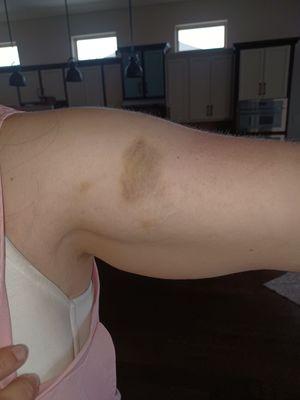 Bruises given by the nurses that restrained my daughter physically.