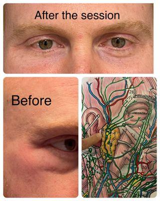 Manual Lymph drainage after cosmetic procedure that resulted in swelling.