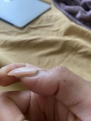 Thumb nail falling off