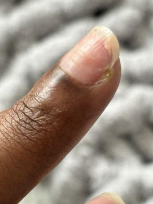 Nail infection. Paronychia.