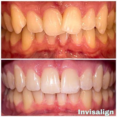 Improved position of crowded teeth with Invisalign clear aligners