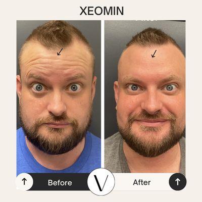 Xeomin before and after