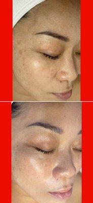 Skin Rejuvenation