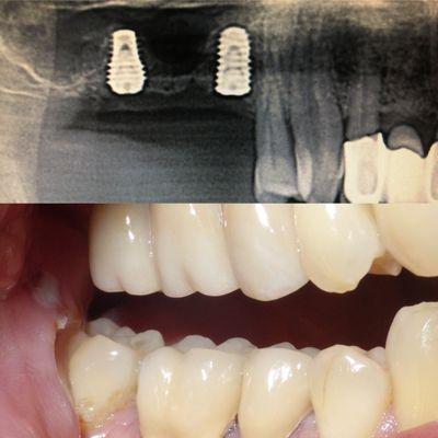 Pt is very happy to have his teeth back that look and function like his natural teeth.We placed a three unit bridge supported by implant