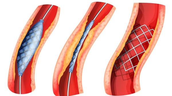 Angioplasty and stenting of clogged arteries