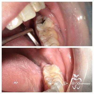 Before and after cavity filling! It's very important to get any cavities filled before they develop into more serious conditions!