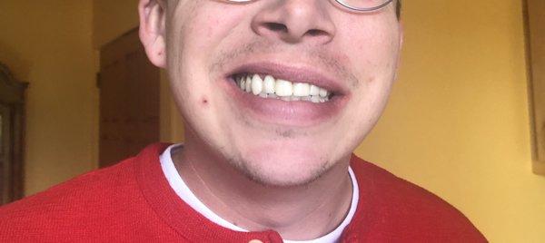 His new porcelain veneers (6 front teeth)