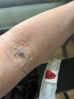 Blown vein, happened last year too.