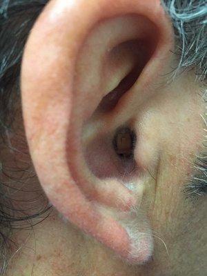 The smallest invisible solution called IIC is proudly offered at Advanced Hearing Solutions-Westborough