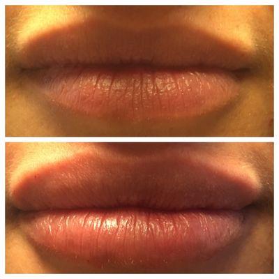 Filler Lip Injection Before & After (1 syringe)