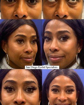 This stunning patient from Los Angeles underwent scarless lower eyelid blepharoplasty with fat repositioning by Dr. Iyengar.