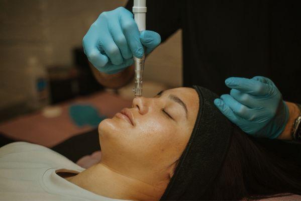 Microneedling with Growth Factors