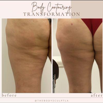 3 Sessions of the cellulite treatment