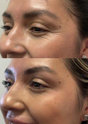 Botox treatment on lateral canthus (crows feet). Units will vary for each patient.