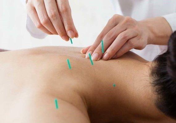 Acupuncture