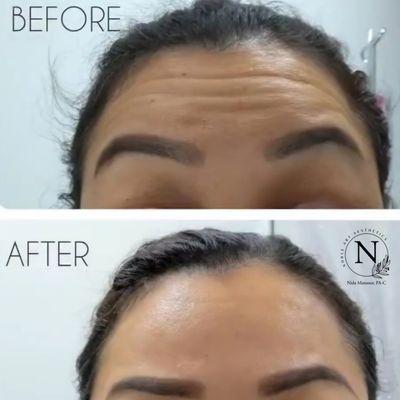 Botox Treatment Before and After