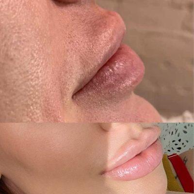 Before & after of my lips with Melanie