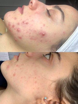 Before and after results from acne bootcamp