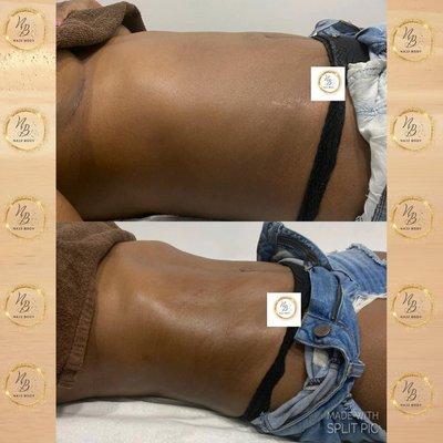 before and after 6 session post surgery lymphatic drainage