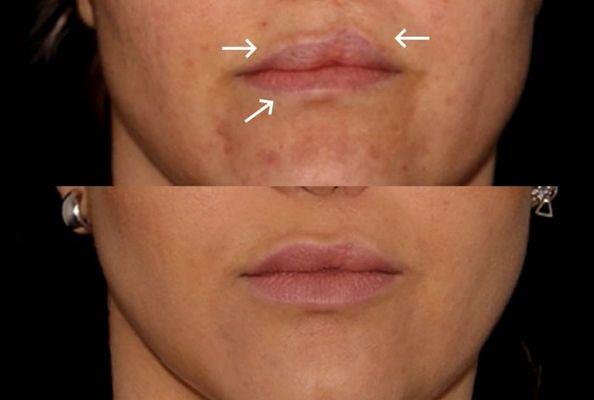 cleft lip treatment