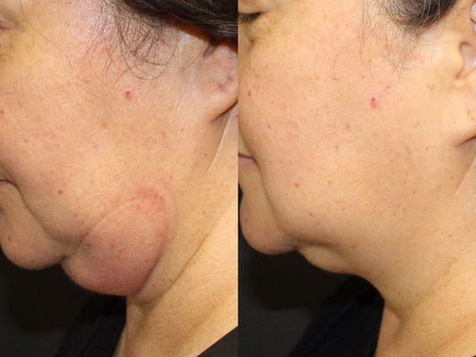 Chin CoolSculpting after 2 rounds of treatment