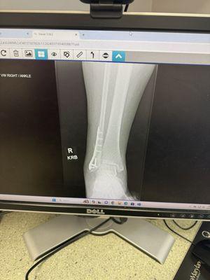 Right ankle xray after surgery ~ All healed