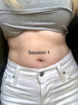 Before laser lipo (LED) - Session 1