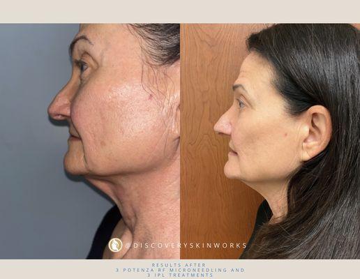 Results after 3 Potenza RF Microneedling and 3 IPL treatments. We targeted fine lines and wrinkles, discoloration, and more!