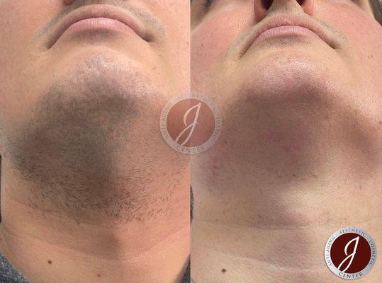 Chin Laser Hair Removal