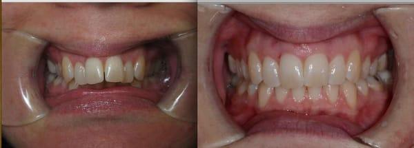 Invisalign Before/After.