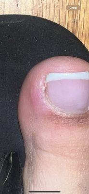 Infection from pedicure