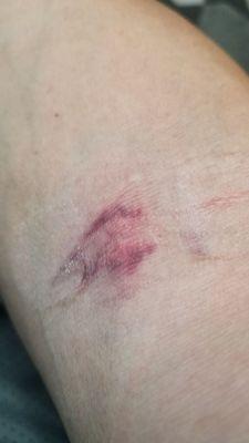 Thirteen hours after blood draw