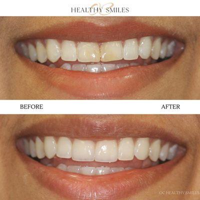 Our dentists replaced old, discolored bonding with all porcelain veneers creating a natural & enhanced smile