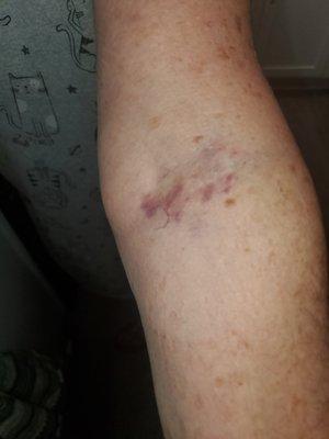 Arm after inserting IV