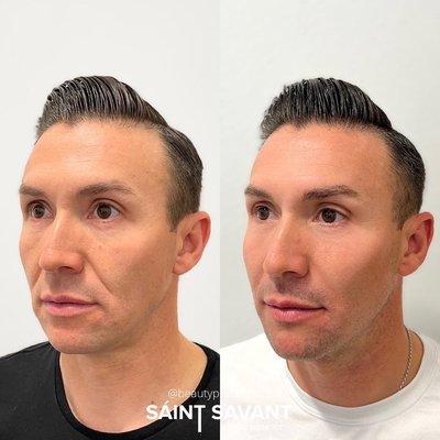 Nonsurgical MALE FACIAL BALANCING, RESTORED lost VOLUME using dermal filler