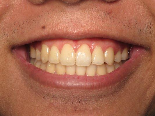 Teeth after Invisalign treatment at Bittner Family Dental Group