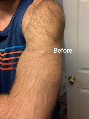 Before laser hair removal on arms.