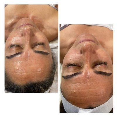 Before and after 1st DMK Skin Revision treatment