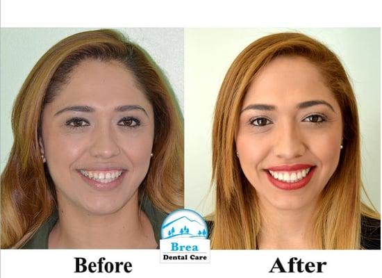 Nayeli (now one of our employees) Before and After her Veneers!