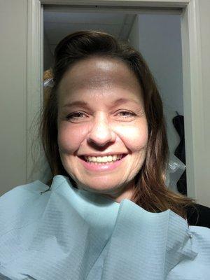 First try-on of new front teeth fit perfectly! Feels great to smile wide again! Thank you Orly!