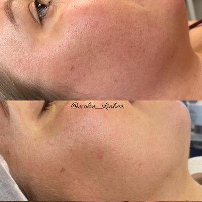 Microneedling with customized facials