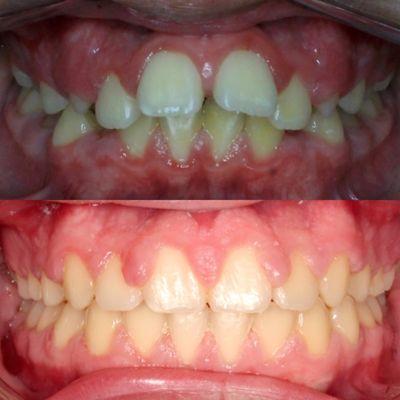 -Expanded upper and lower arches
-Reduce flaring of front teeth
-Opened deep overbite
Total treatment time 27 months