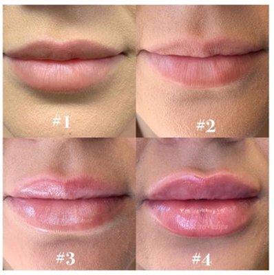 Nurse Denise and Adrianne teamed up over the course of 3 treatments to dissolve, correct and perfect these previously over filled lips.